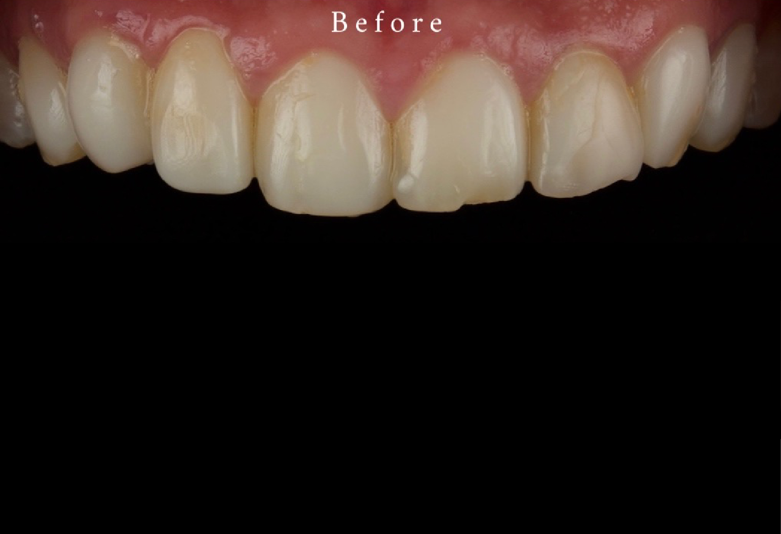 Veneers Image 02