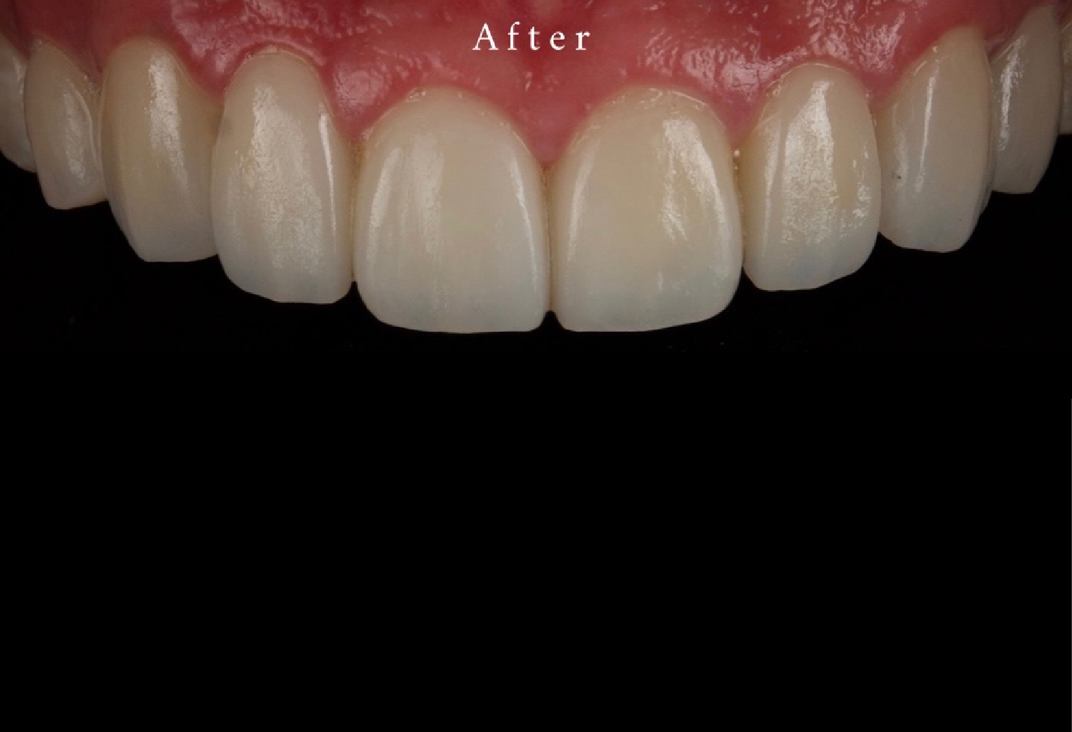 Veneers Image 03